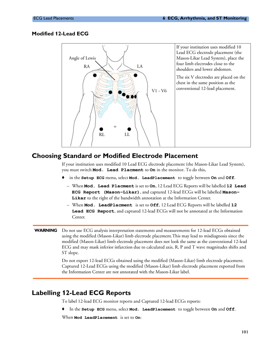 Philips MP20/30 Choosing Standard or Modified Electrode Placement, Labelling 12-Lead ECG Reports, Modified 12-Lead ECG 