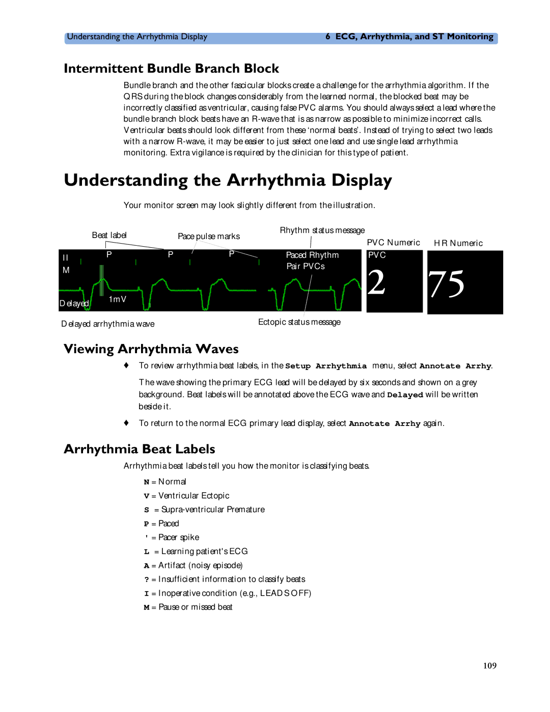 Philips MP60/70/80/90 Understanding the Arrhythmia Display, Intermittent Bundle Branch Block, Viewing Arrhythmia Waves 