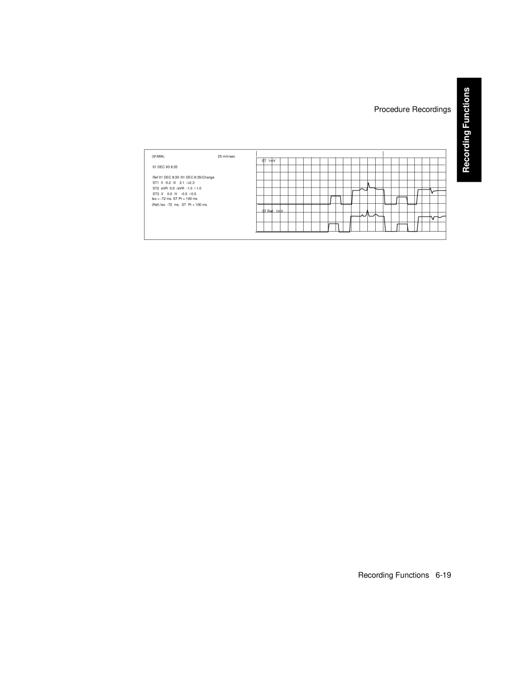 Philips V24CT, V26CT manual Procedure Recordings Recording Functions 